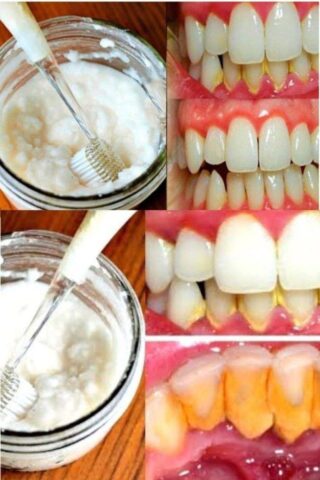 Tartar Removal: 24 Methods, Results Within 3 Days