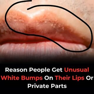 Why You Might See Unusual White Bumps On Your Lips Or Genitals