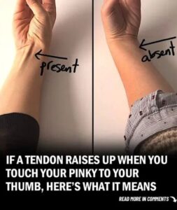 What It Means If You Have That Tendon in Your Wrist (And Why Some People Don’t)