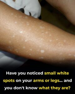 Small White Spots on Your Arms or Legs? Here’s What They Really Are (And Why You Don’t Need to Worry)